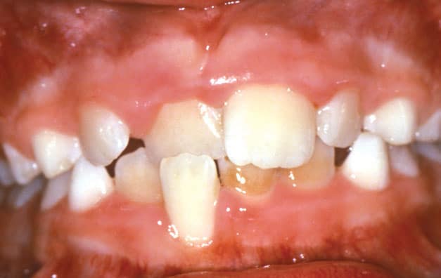 Crossbite Grey Orthodontics in Mandeville and Kingston, Jamaica