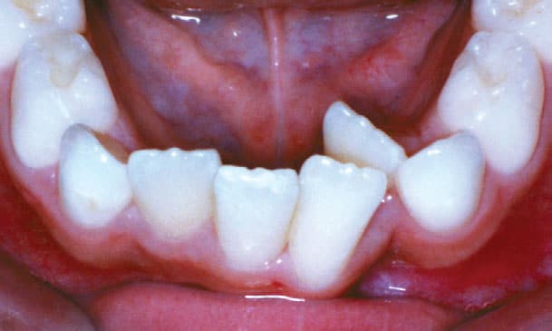Crowding Grey Orthodontics in Mandeville and Kingston, Jamaica