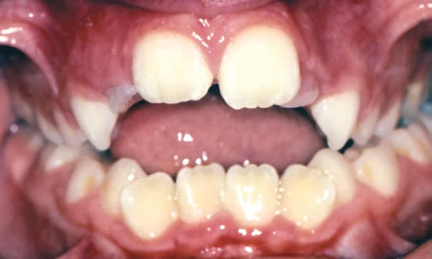 Open Bite Grey Orthodontics in Mandeville and Kingston, Jamaica
