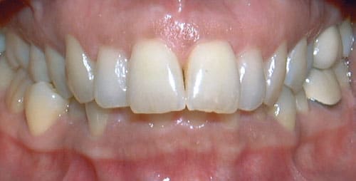 Overbite Grey Orthodontics in Mandeville and Kingston, Jamaica