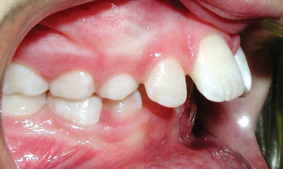 Protrusion Grey Orthodontics in Mandeville and Kingston, Jamaica