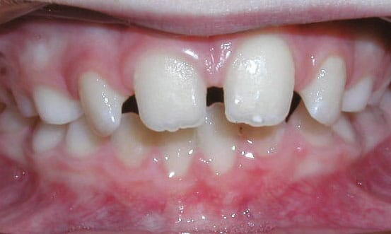 Spacing Grey Orthodontics in Mandeville and Kingston, Jamaica