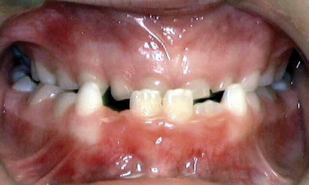 Underbite Grey Orthodontics in Mandeville and Kingston, Jamaica